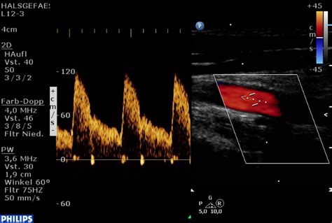 doppler maternaler gefäße|Doppler maternale Gefäße